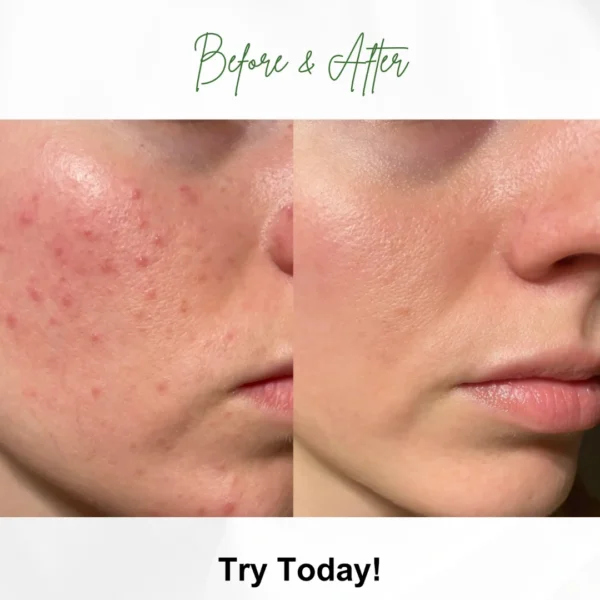 Lemon Face Wash With SPF 60 Sunscreen Combo For Acne-Prone Skin